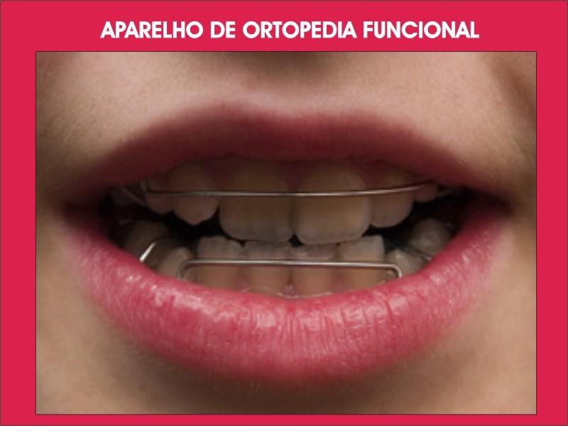 Ortodontia Preventiva
